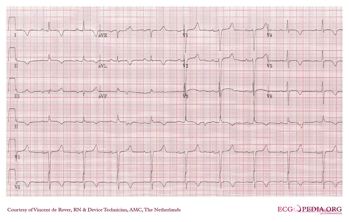 Amc Case 158 - Ecgpedia