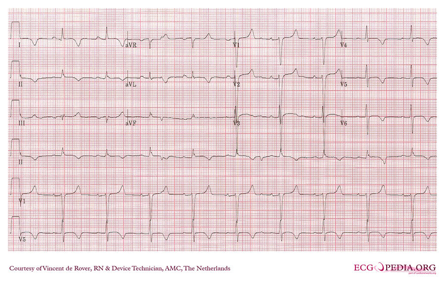 AMC Case 158 - ECGpedia