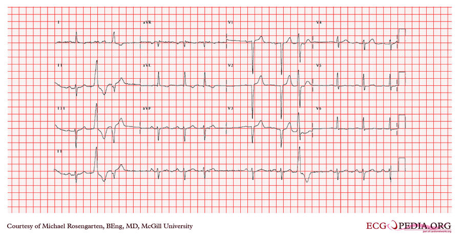 McGill Case 365 - ECGpedia