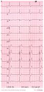 De Voogt ECG Archive - Arrhythmias - ECGpedia