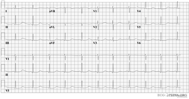 File:Lqts1.png - ECGpedia