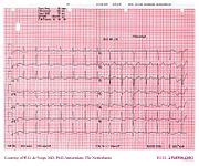 De Voogt ECG Archive - Electrolyte Disorders - ECGpedia