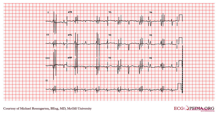 McGill Case 176 - ECGpedia