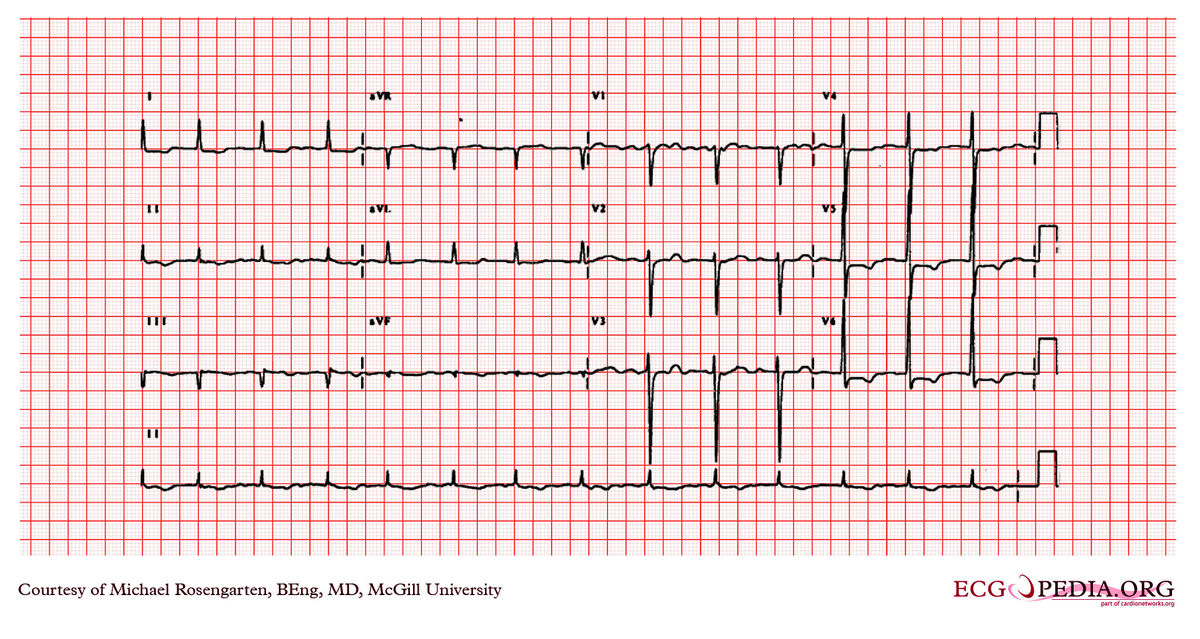 McGill Case 252 - ECGpedia