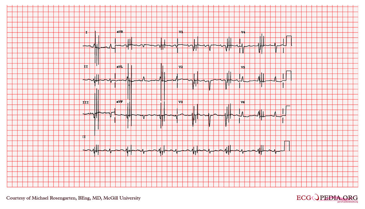 mcgill-case-294-ecgpedia