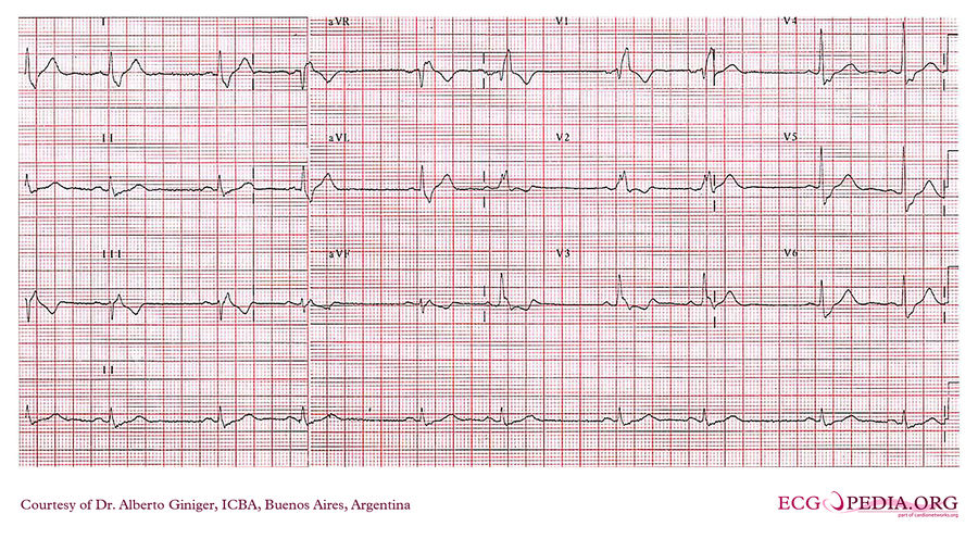 ICBA10 - ECGpedia