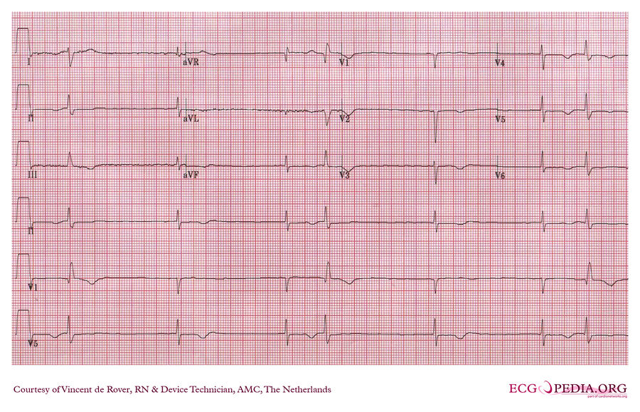 AMC Case 80 - ECGpedia