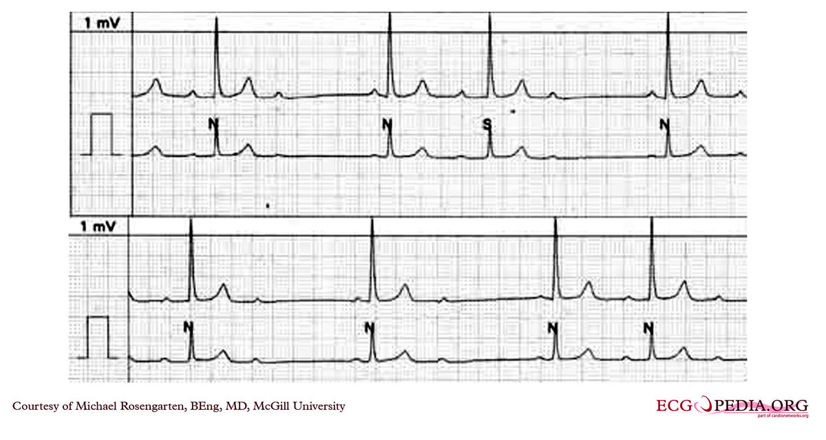 File:E267.jpg - ECGpedia