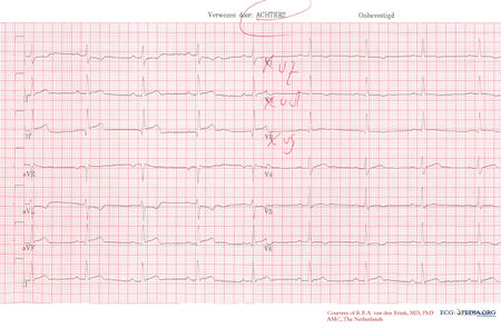 Example 23 - ECGpedia