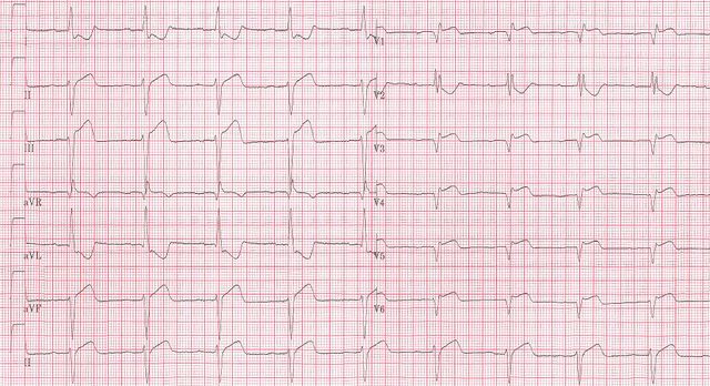 File:RBBB inf MI V4R.jpg - ECGpedia