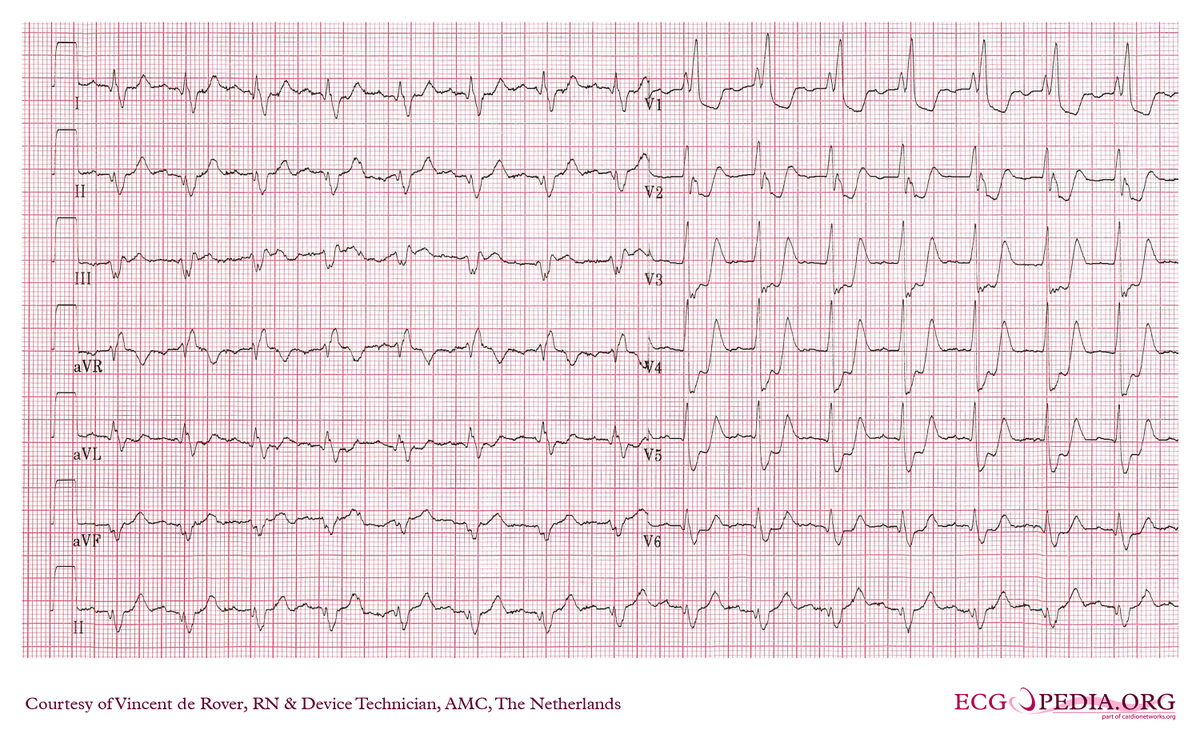 AMC Case 203 - ECGpedia