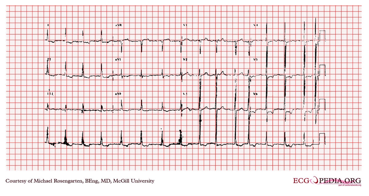 McGill Case 273 - ECGpedia