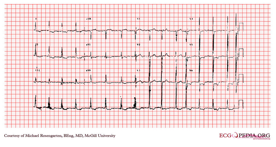 Mcgill Case 273 - Ecgpedia