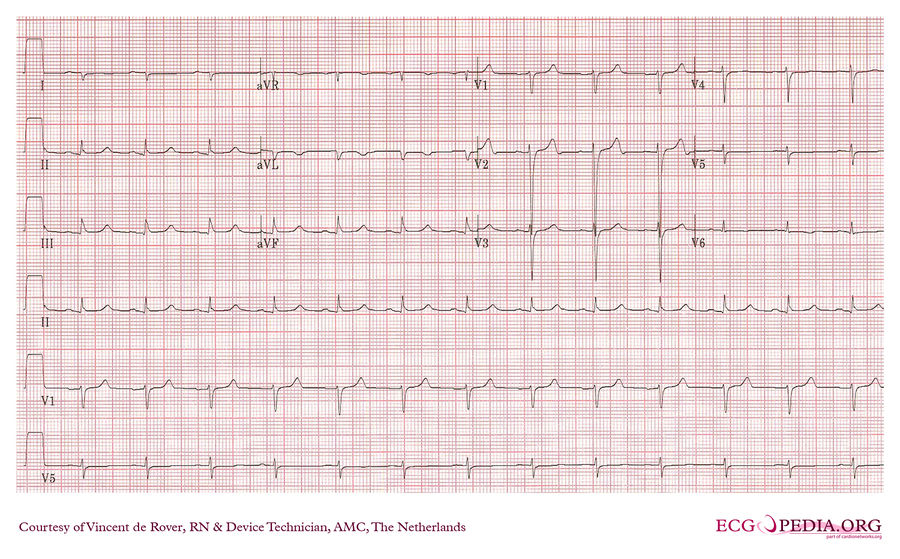 AMC Case 167 - ECGpedia