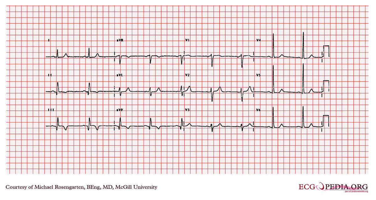 McGill Case 200 - ECGpedia