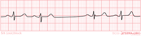 Sino-atrial Exit Block - Ecgpedia