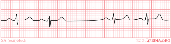 Sino-atrial exit block - ECGpedia