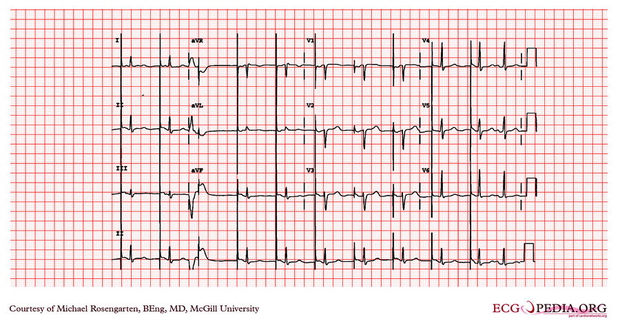 McGill Case 114 - ECGpedia