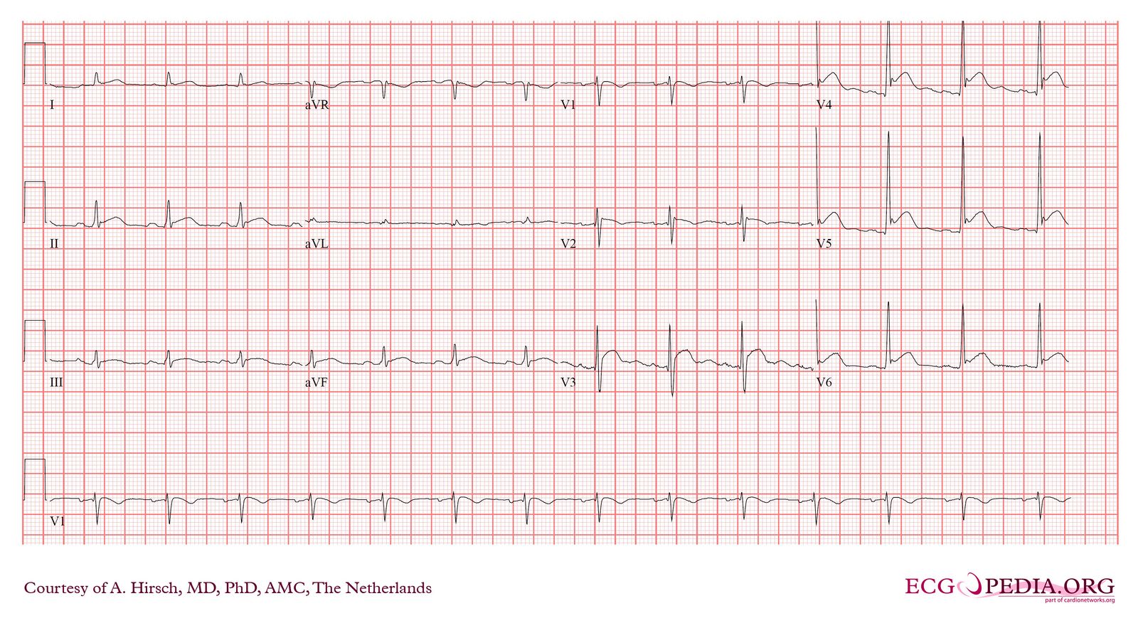 Answer - Case of the month (Aug 2011) - ECGpedia