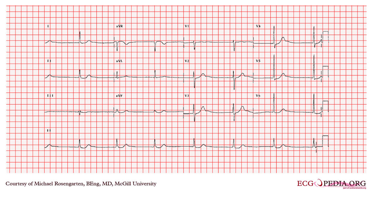 McGill Case 351 - ECGpedia