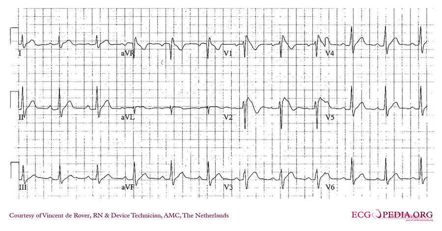 Amc Case 160 Ecgpedia