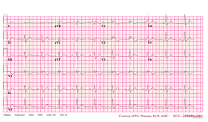 De-Brugada syndrome type1 example3.png
