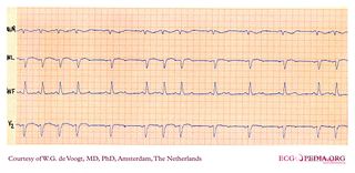 File:DVA0785.jpg - ECGpedia