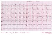 De Voogt ECG Archive - Intraventricular Conduction - ECGpedia