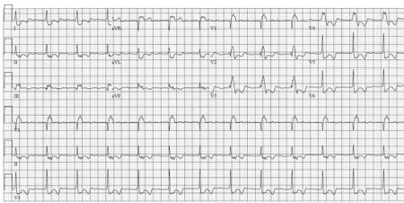 Puzzle 2005 12 466 - Answer - ECGpedia