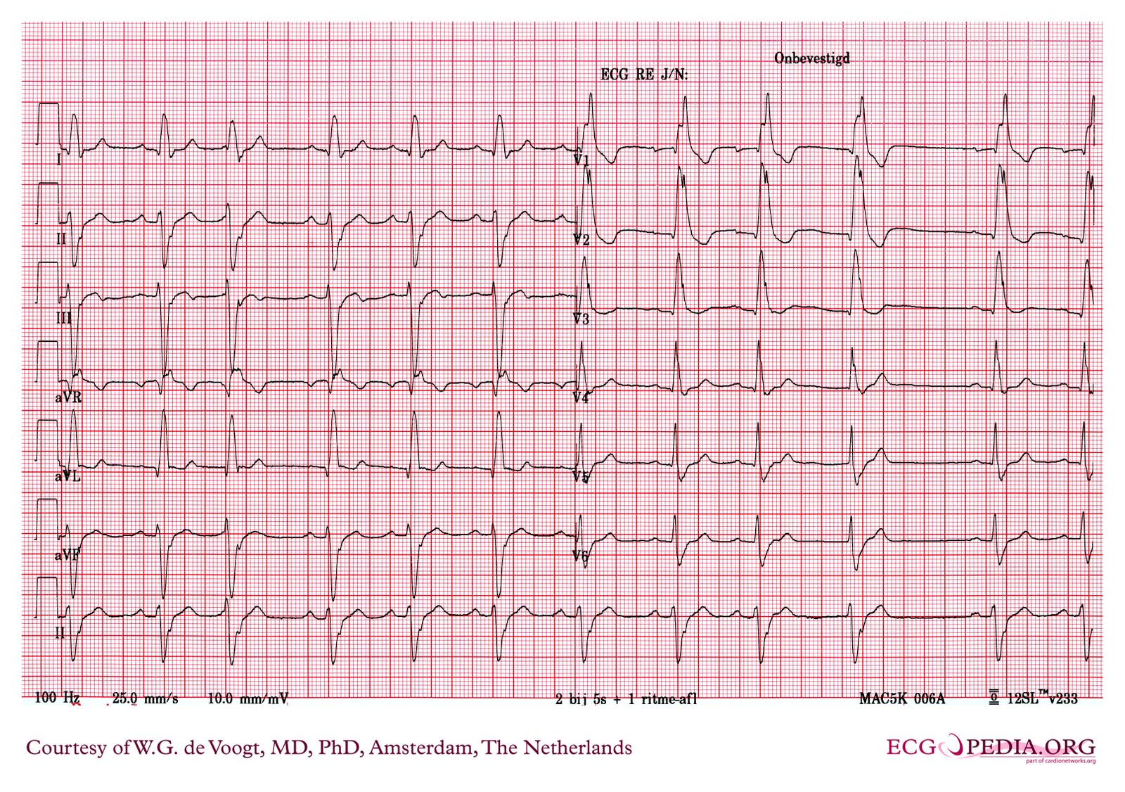 File:DVA0335.jpg - ECGpedia