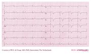 De Voogt ECG Archive - Myocardial Infarction - Anterior - ECGpedia