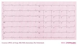 myocardial infarction ecg interpretation