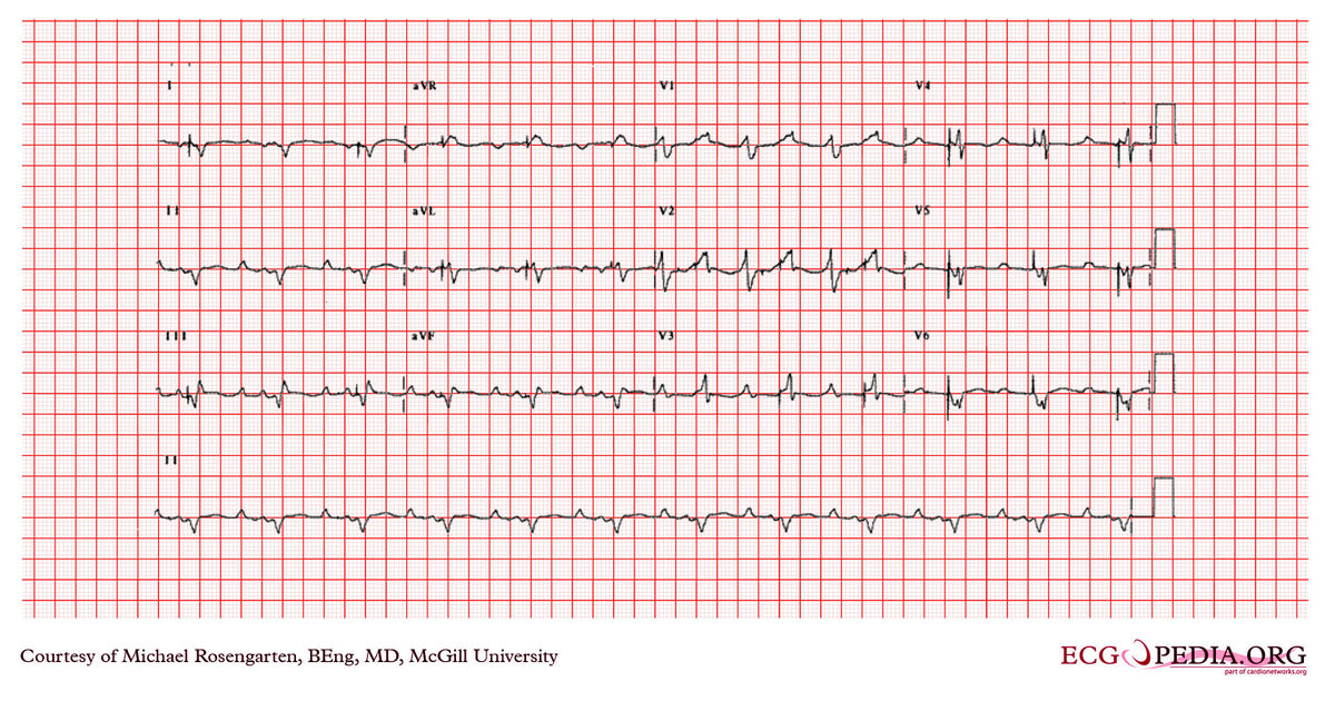 McGill Case 377 - ECGpedia