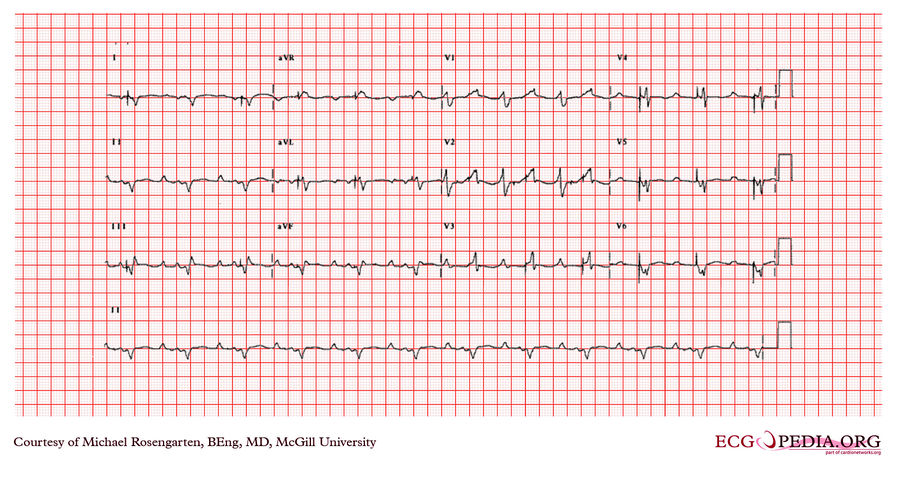 McGill Case 377 - ECGpedia