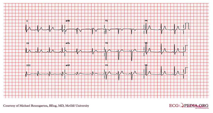 McGill Case 182 - ECGpedia