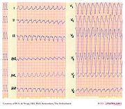 De Voogt ECG Archive - Ventricular Arrhythmias - ECGpedia