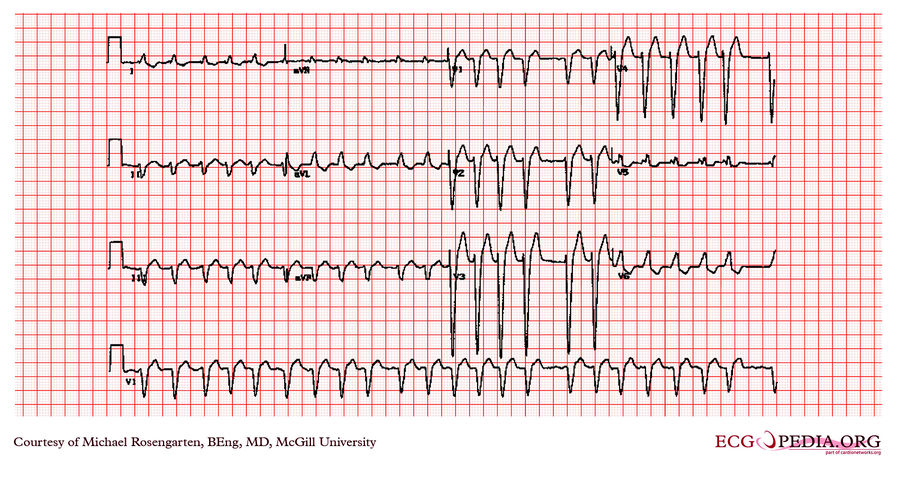 McGill Case 311 - ECGpedia