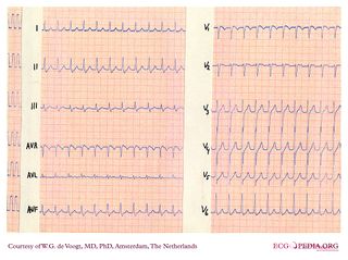 File:DVA0312.jpg - ECGpedia