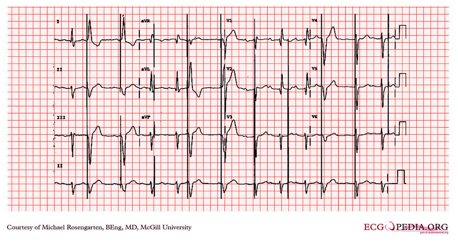 McGill Case 229 - ECGpedia