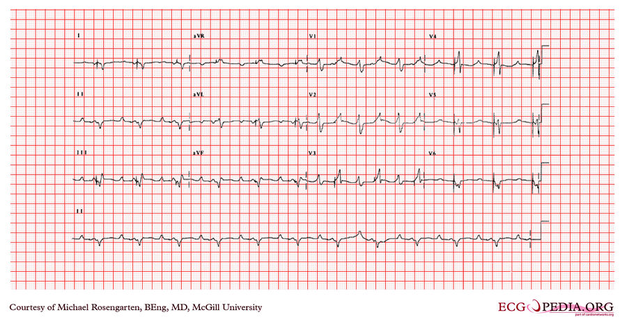 McGill Case 352 - ECGpedia