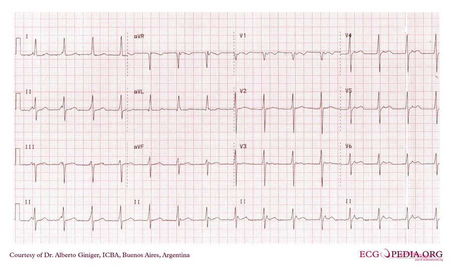 Icba41 - Ecgpedia