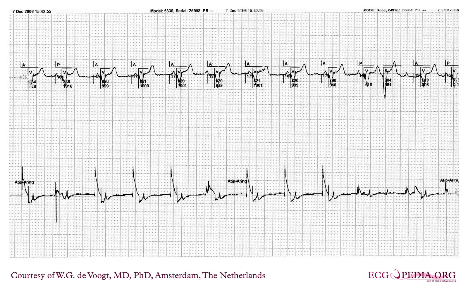 File:DVA1771.jpg - ECGpedia