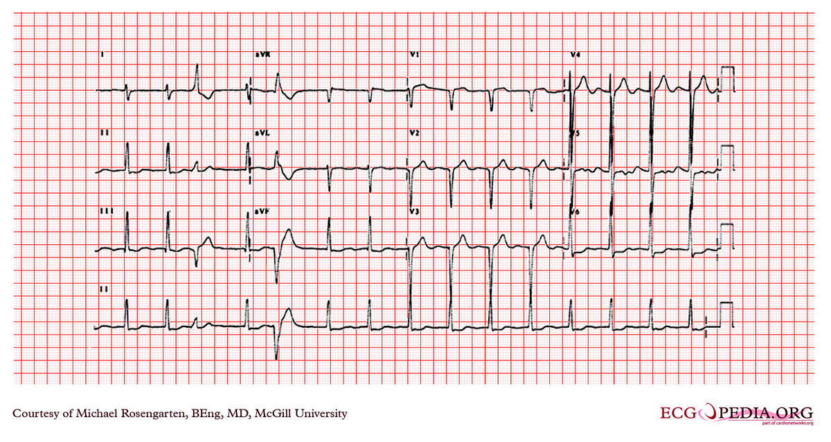 McGill Case 230 - ECGpedia