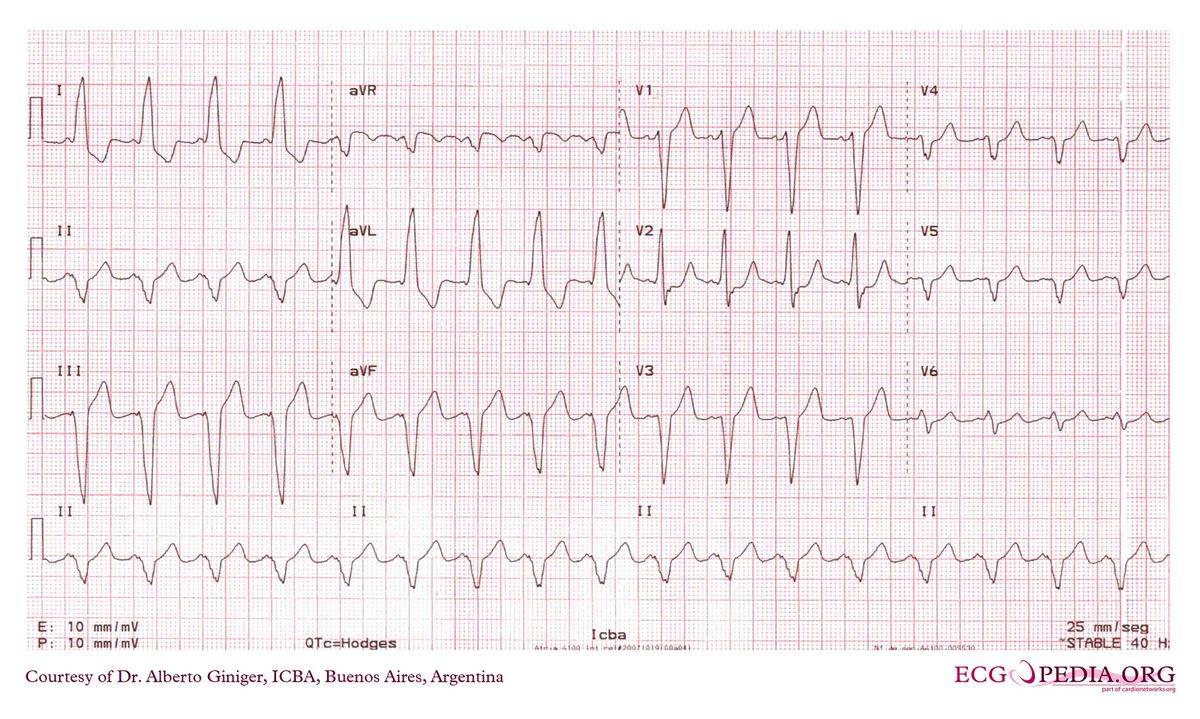 ICBA45 - ECGpedia