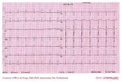 De Voogt ECG Archive - Myocardial Infarction - Anterior - ECGpedia