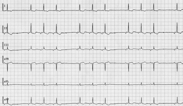 An Irregular Heart Beat - ECGpedia