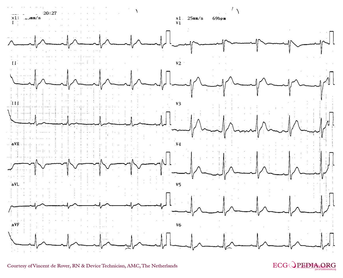 Amc Case 160 Ecgpedia