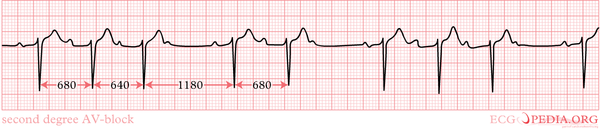 AV Conduction - ECGpedia