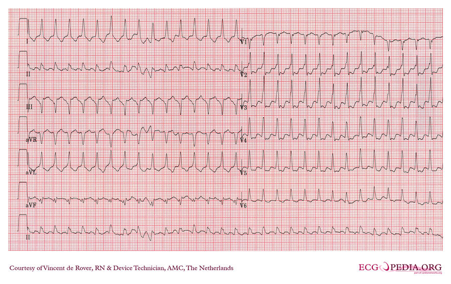 AMC Case 219 - ECGpedia