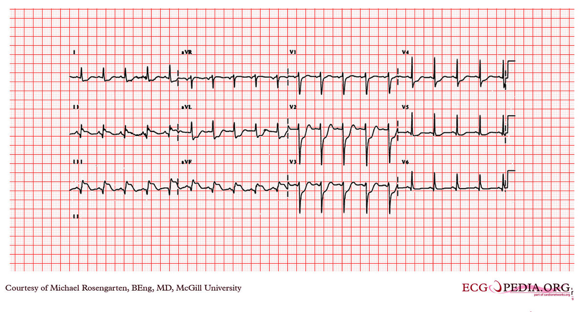 McGill Case 91 - ECGpedia